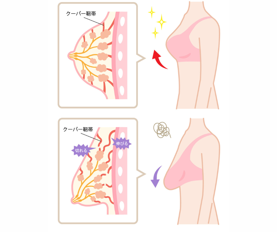 クーパー靭帯を守る！今ある形を崩さない守ることの重要性